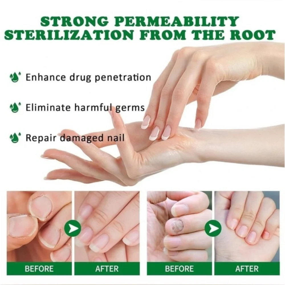 JAYSUING Nail Fungus Treatment - NEW IN SEALED BOX - fingernail toenail